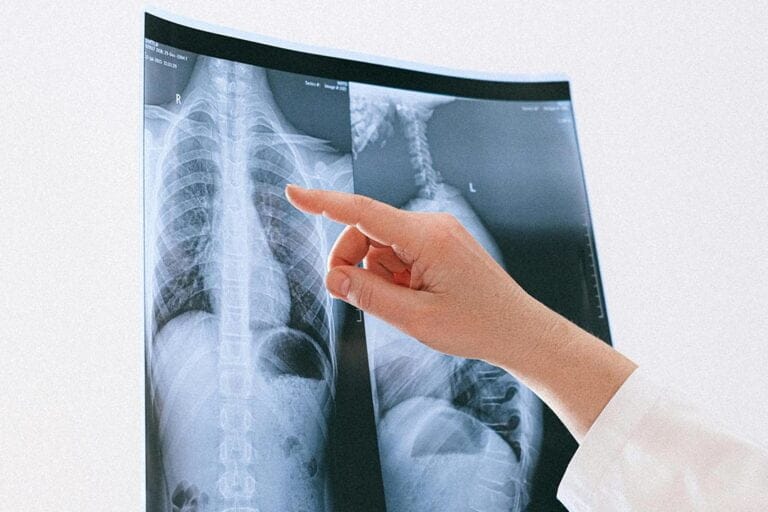 medico diagnosticando una fractura vertebral