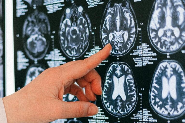 Que es una craneotomía