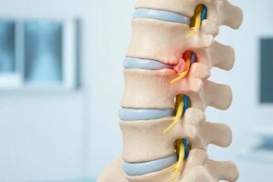 Columna vertebral con estrechamiento de canal después de una foraminotomía lumbar