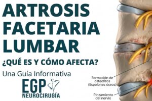 artrosis facetaria lumbar